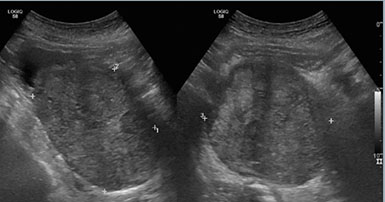 prostate ultrasound images